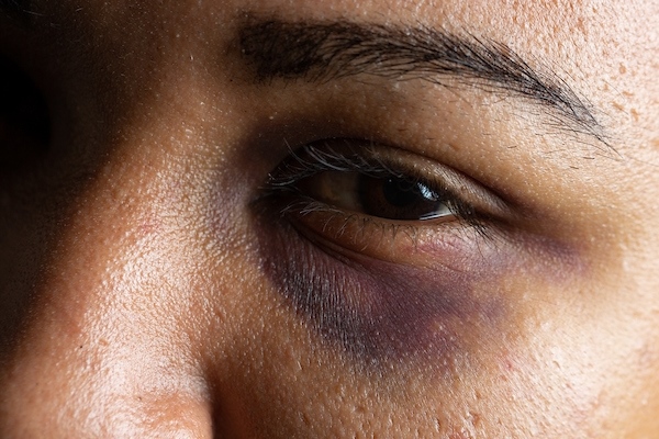 Foto colorida mostra olho roxo de mulher agredida fisicamente