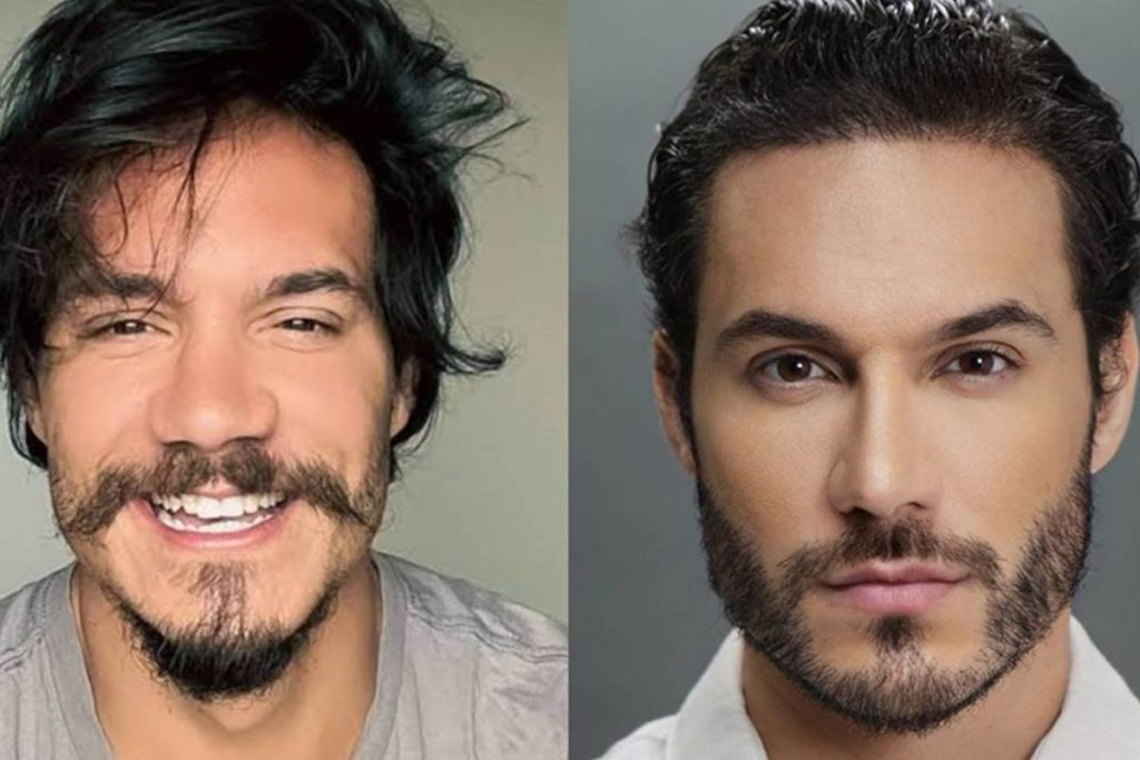 Foto colorida de Eliezer antes e depois de fazer procedimentos estéticos no rosto - Metrópoles