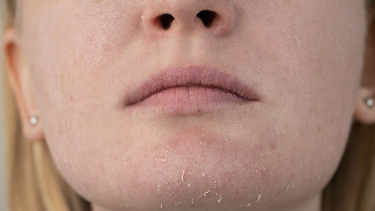Pele do rosto fica mais ressecada durante o frio e é preciso redobrar atenção do skin care - Metrópoles