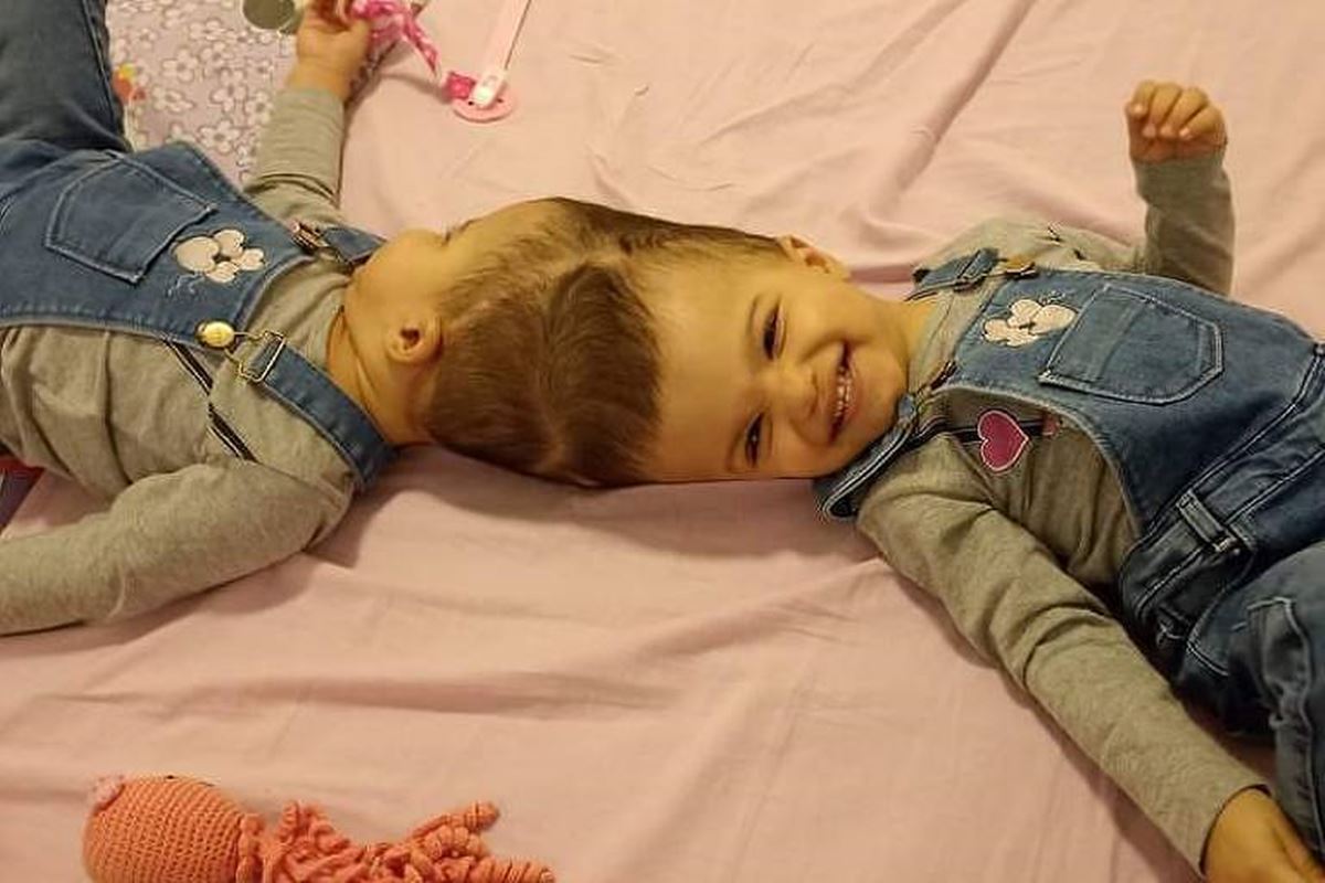 Foto de gêmeas siamesas ligadas pela cabeça, deitadas em cama e sorrindo - Metrópoles