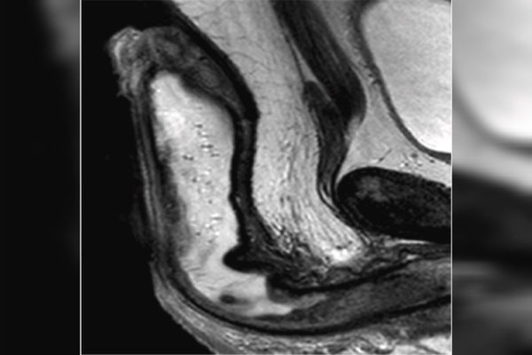 Imagens de ressonância magnética revelam líquido que preenchia o pênis do homem (em branco)