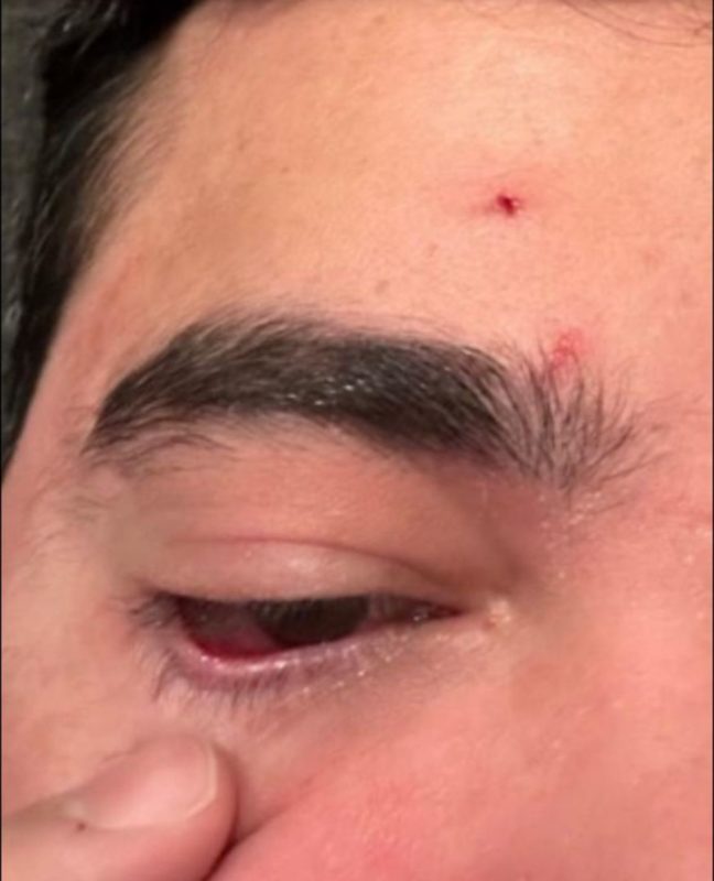 Fábio Gontijo com o rosto machucado