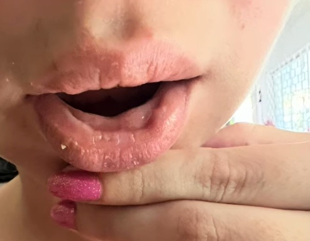 reação alérgica ao preenchimento labial