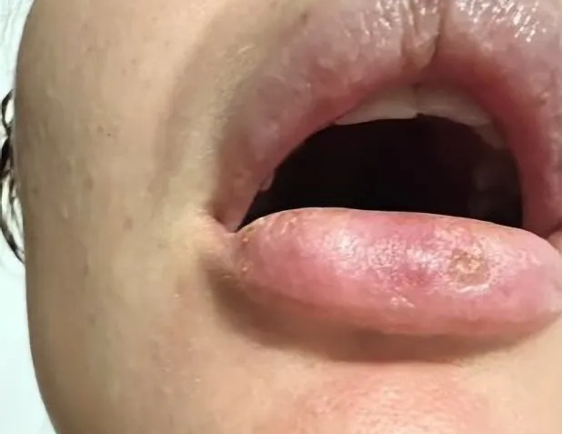 reação alérgica a preenchimento labial