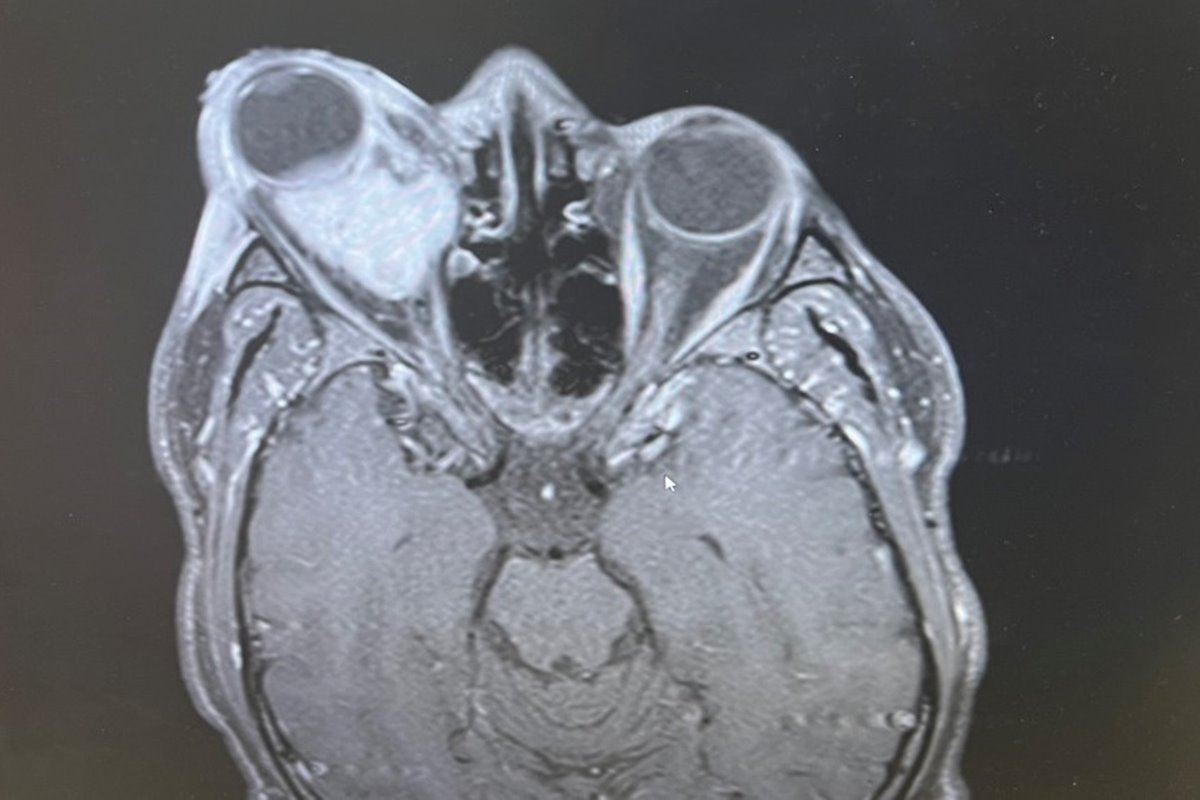 Imagem de ressonância mostra câncer em olho - Metrópoles