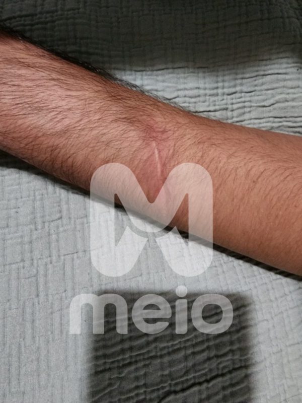 Ator Caio Antures mostra os cortes no braço feitos pela ex - Metrópoles
