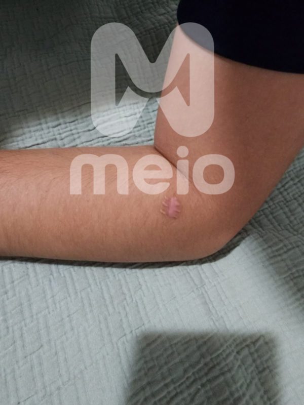 Ator Caio Antures mostra os cortes no braço feitos pela ex - Metrópoles
