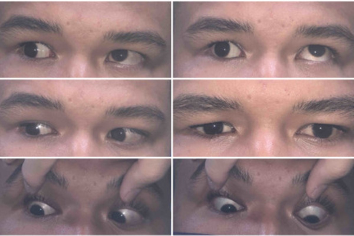 Imagem mostra seis fotografias dos olhos de um homem em várias posições - Metrópoles