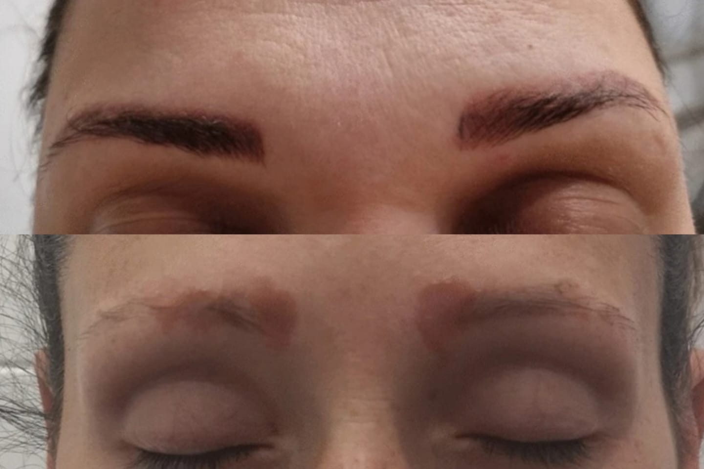 Women suffer from lung damage after having eyebrow plastic surgery