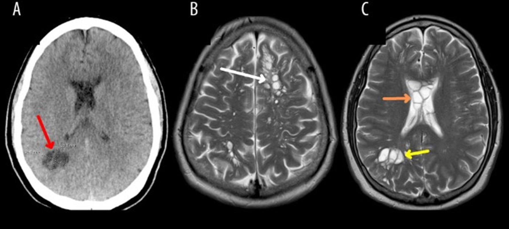 Imagem de ressonância do cérebro mostra cistos - Metrópoles