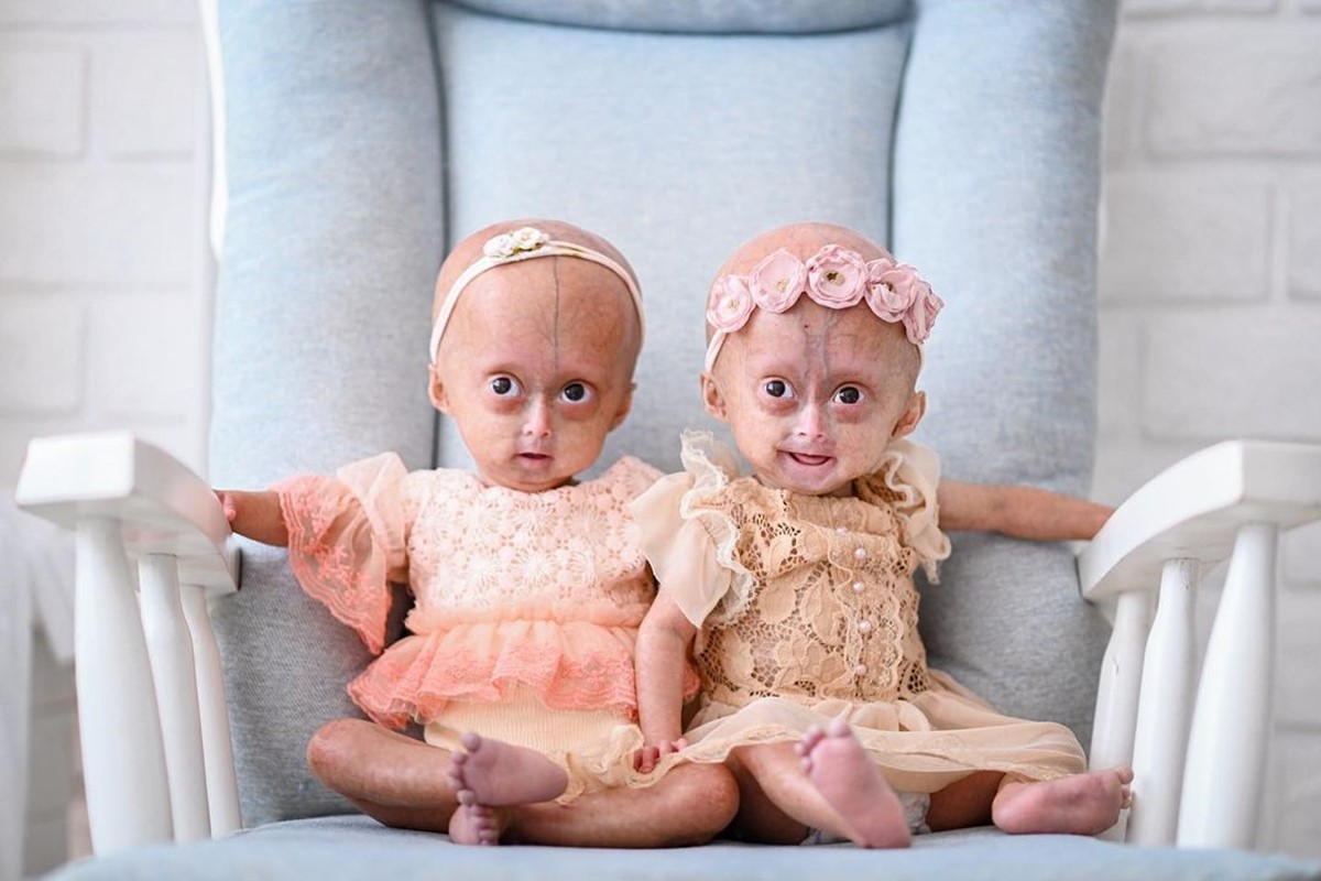 Foto colorida de duas meninas sentadas em poltrona. Elas têm a síndrome progeria - Metrópoles